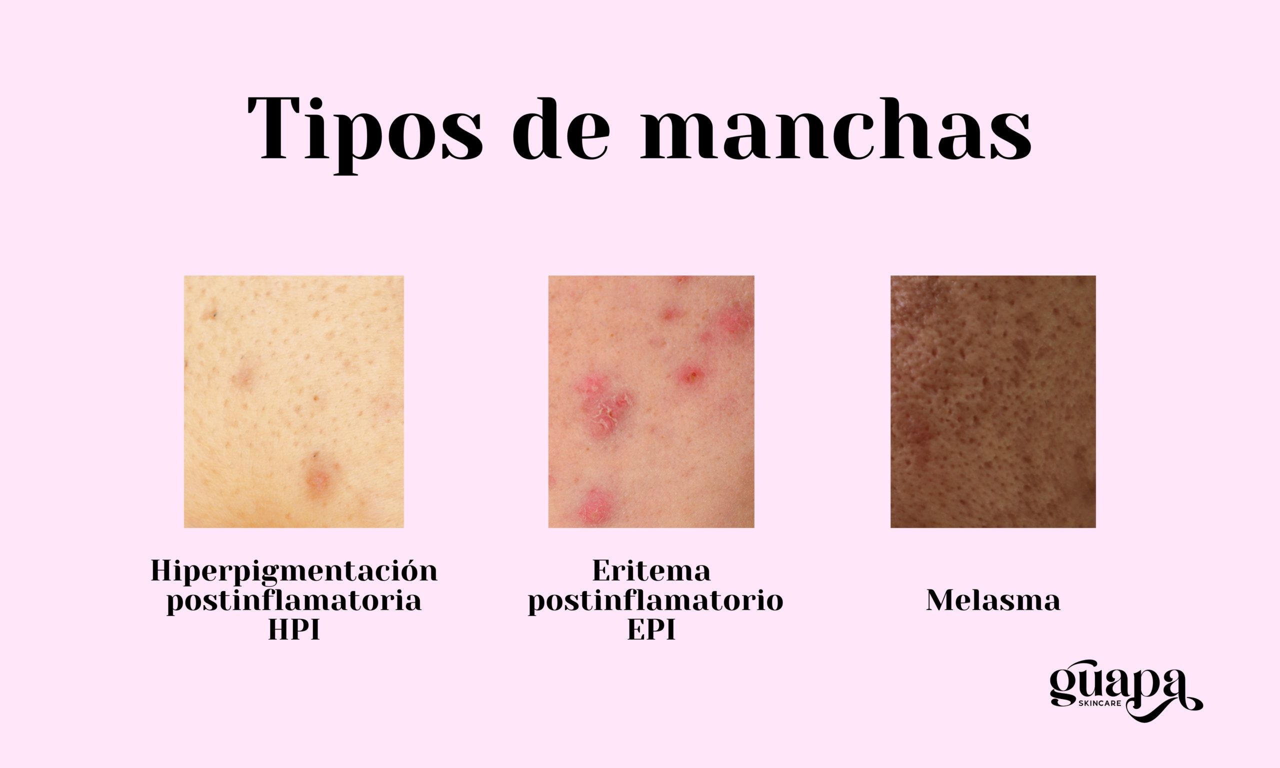 Tipos de manchas